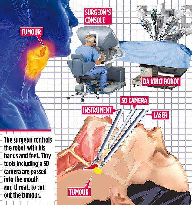 碰到難以觸及到的咽喉腫瘤問題怎么辦？機器人來解決